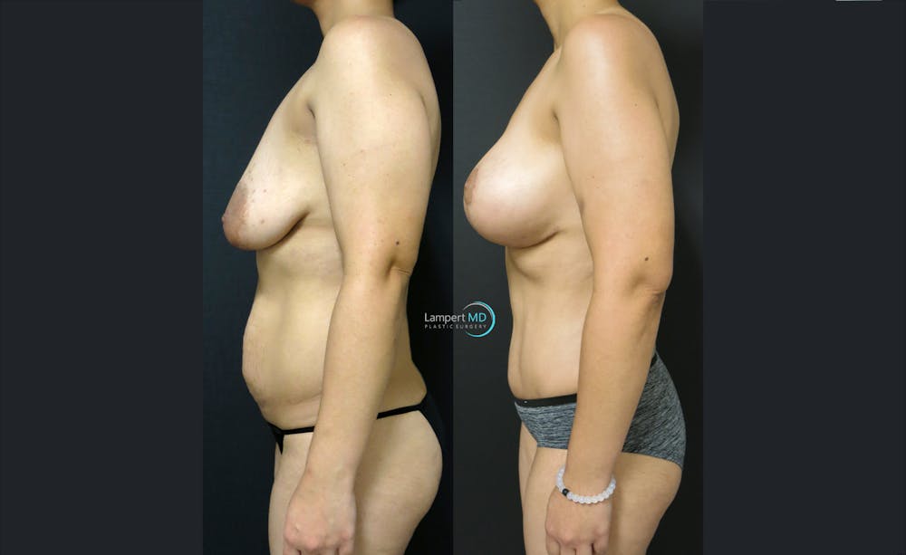 Tummy Tuck Before & After Gallery - Patient 122909179 - Image 3