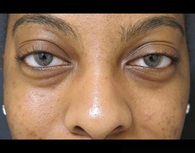 Fillers Before & After Gallery - Patient 122909183 - Image 1