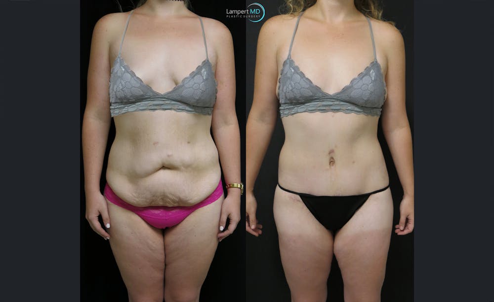 Tummy Tuck Before & After Gallery - Patient 122909188 - Image 1