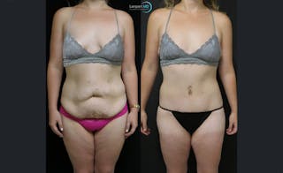 Tummy Tuck Before & After Gallery - Patient 122909188 - Image 1