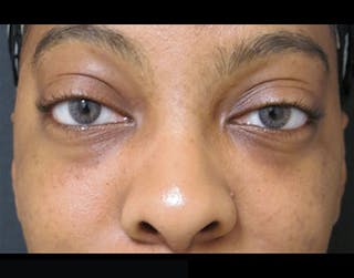 Fillers Before & After Gallery - Patient 122909183 - Image 2