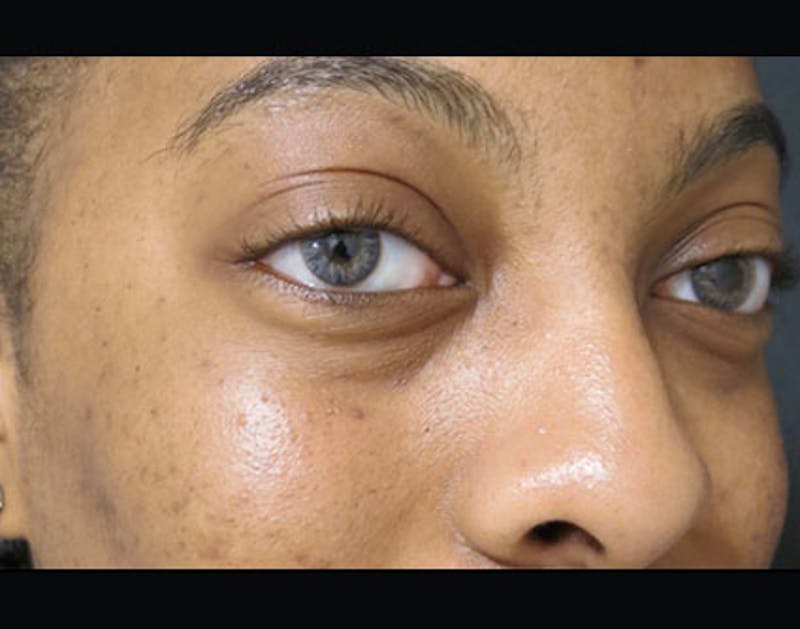 Fillers Before & After Gallery - Patient 122909183 - Image 3