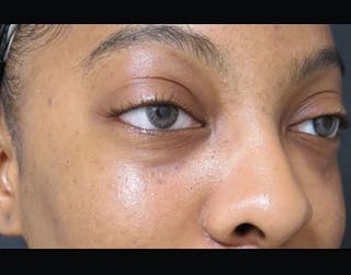 Fillers Before & After Gallery - Patient 122909183 - Image 4