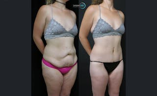 Tummy Tuck Before & After Gallery - Patient 122909188 - Image 2