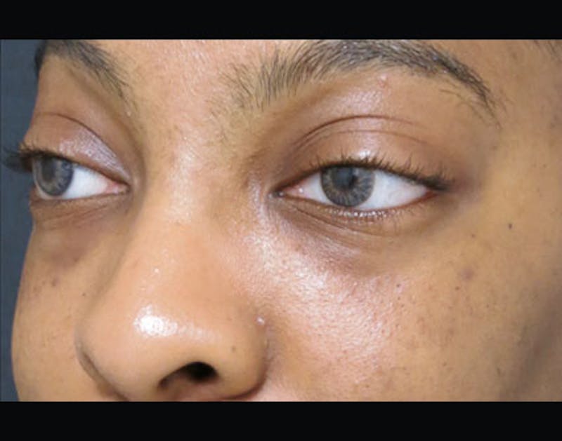 Fillers Before & After Gallery - Patient 122909183 - Image 6