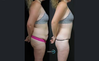 Lower Body Lift Before & After Gallery - Patient 311029 - Image 3