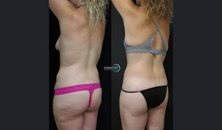 Lower Body Lift Before & After Gallery - Patient 311029 - Image 4