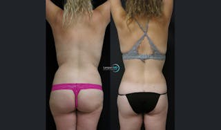 Tummy Tuck Before & After Gallery - Patient 122909188 - Image 5