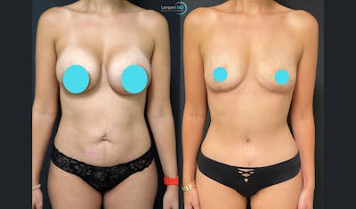Tummy Tuck Before & After Gallery - Patient 122909193 - Image 1