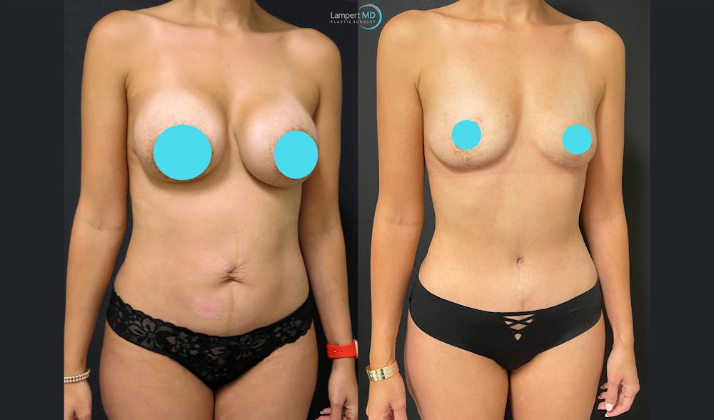 Tummy Tuck Before & After Gallery - Patient 122909193 - Image 2