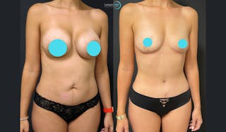 Tummy Tuck Before & After Gallery - Patient 122909193 - Image 2
