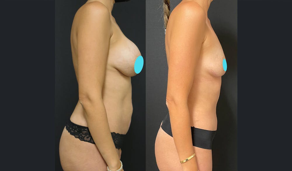 Tummy Tuck Before & After Gallery - Patient 122909193 - Image 3