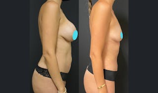 Tummy Tuck Before & After Gallery - Patient 122909193 - Image 3