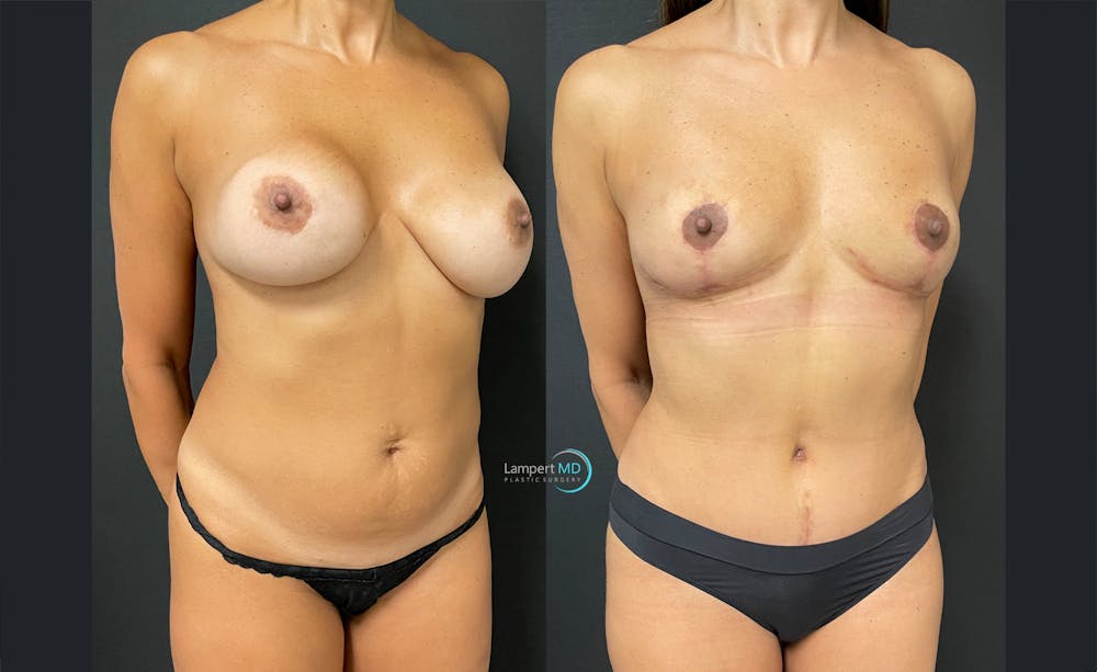 Tummy Tuck Before & After Gallery - Patient 122909196 - Image 2
