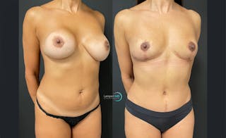 Tummy Tuck Before & After Gallery - Patient 122909196 - Image 2