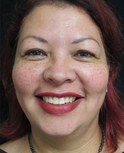 Liquid Facelift Before & After Gallery - Patient 122909201 - Image 2