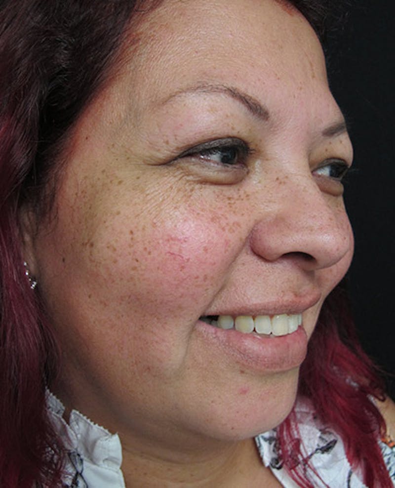 Liquid Facelift Before & After Gallery - Patient 122909201 - Image 3