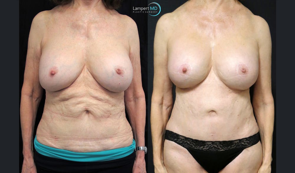 Tummy Tuck Before & After Gallery - Patient 293983 - Image 1