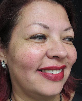Liquid Facelift Before & After Gallery - Patient 122909201 - Image 4