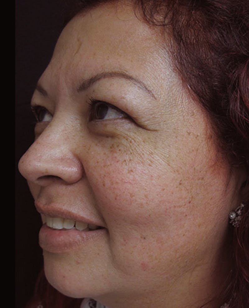 Liquid Facelift Before & After Gallery - Patient 122909201 - Image 5