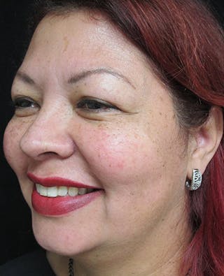 Liquid Facelift Before & After Gallery - Patient 122909201 - Image 6