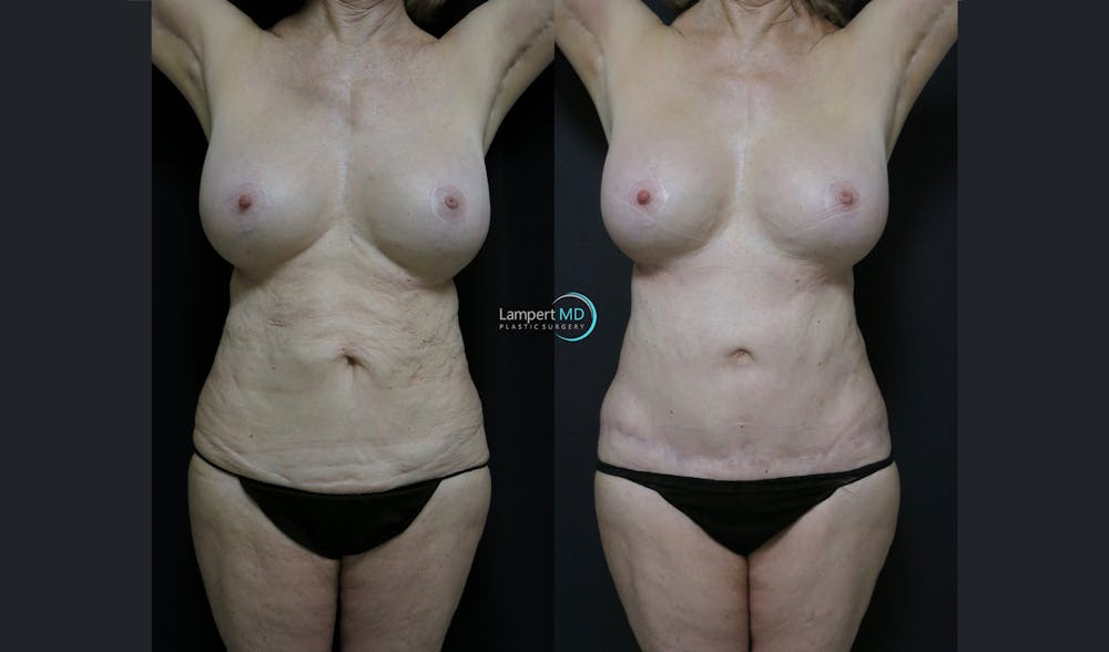 Tummy Tuck Before & After Gallery - Patient 122909208 - Image 2