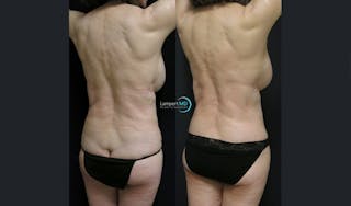 Lower Body Lift Before & After Gallery - Patient 181920 - Image 4