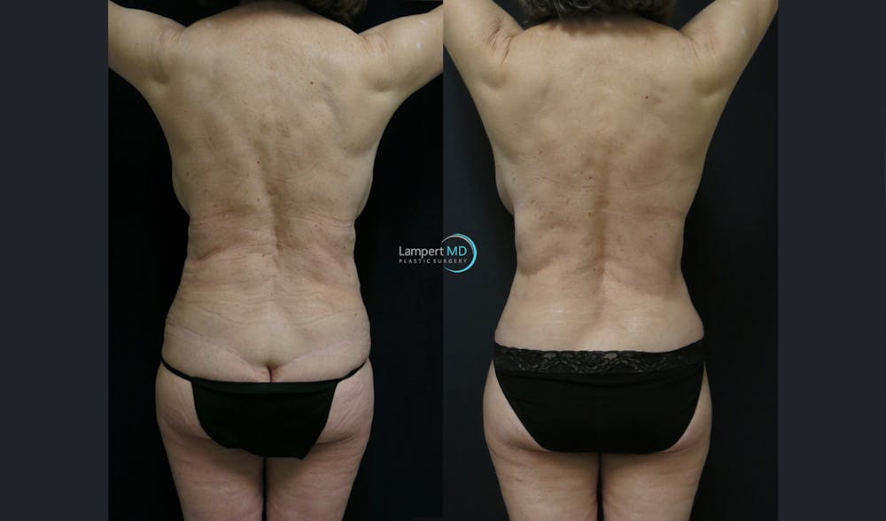 Lower Body Lift Before & After Gallery - Patient 181920 - Image 5