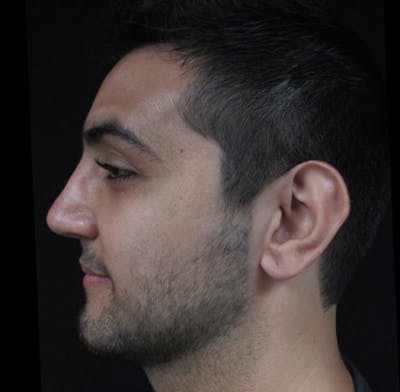 Liquid Rhinoplasty Before & After Gallery - Patient 122909213 - Image 2