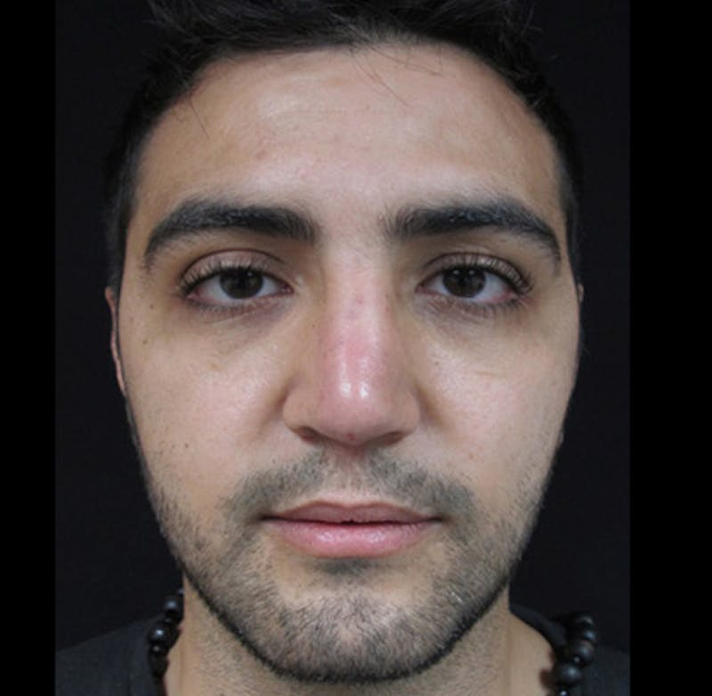 Liquid Rhinoplasty Before & After Gallery - Patient 122909213 - Image 6