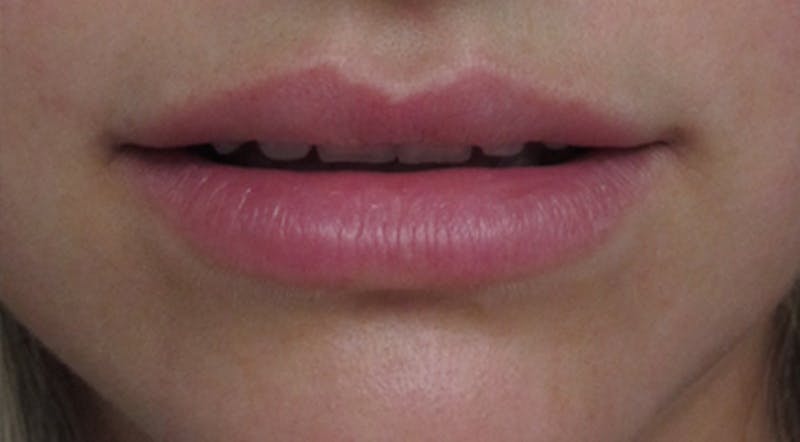 Lip Augmentation Before & After Gallery - Patient 122909216 - Image 1