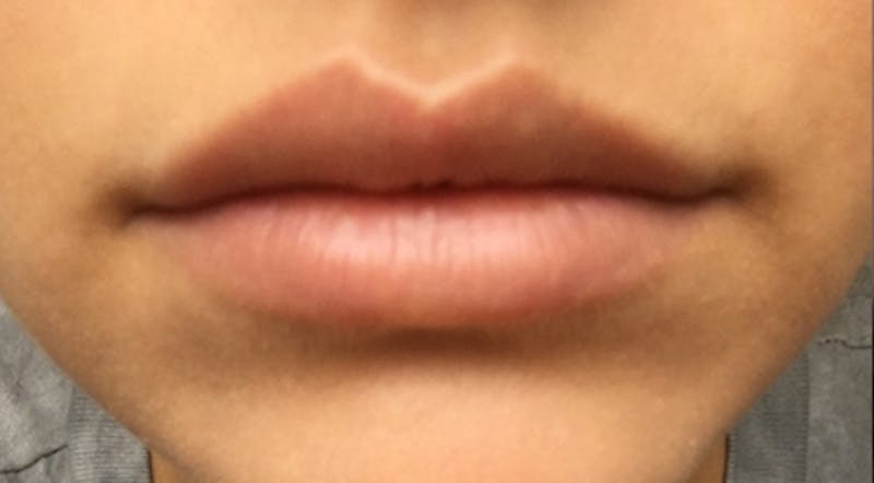 Lip Augmentation Before & After Gallery - Patient 122909216 - Image 2
