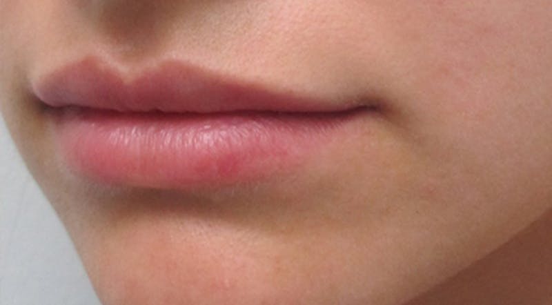 Lip Augmentation Before & After Gallery - Patient 122909216 - Image 3