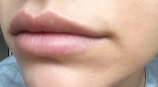 Lip Augmentation Before & After Gallery - Patient 122909216 - Image 4