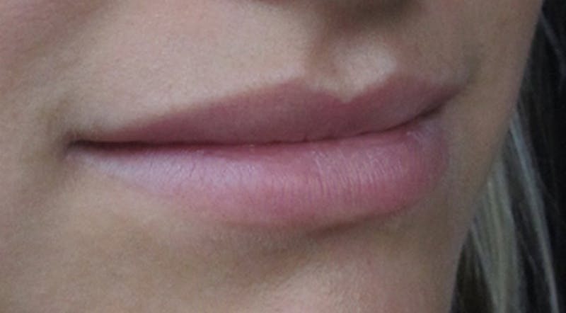 Lip Augmentation Before & After Gallery - Patient 122909216 - Image 5