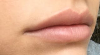 Lip Augmentation Before & After Gallery - Patient 122909216 - Image 6