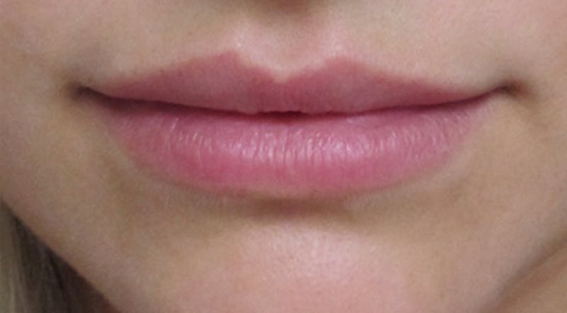 Lip Augmentation Before & After Gallery - Patient 122909216 - Image 7