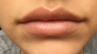 Lip Augmentation Before & After Gallery - Patient 122909216 - Image 8