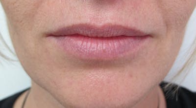 Lip Augmentation Before & After Gallery - Patient 122909218 - Image 1