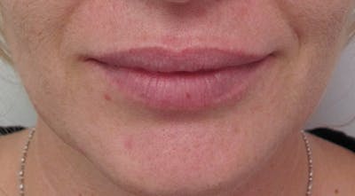 Lip Augmentation Before & After Gallery - Patient 122909218 - Image 2