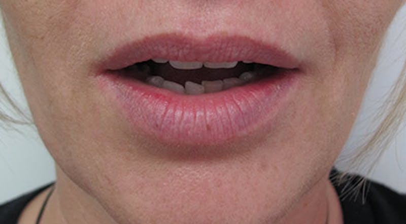 Lip Augmentation Before & After Gallery - Patient 122909218 - Image 3