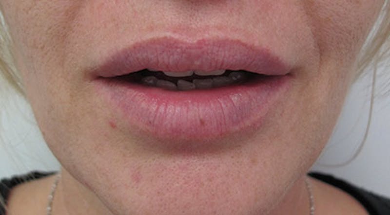 Lip Augmentation Before & After Gallery - Patient 122909218 - Image 4