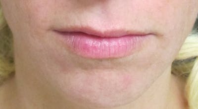 Lip Augmentation Before & After Gallery - Patient 122909219 - Image 1