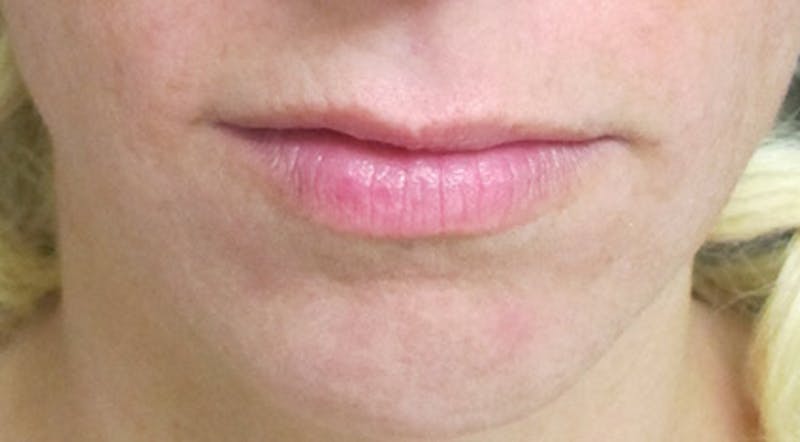 Lip Augmentation Before & After Gallery - Patient 122909219 - Image 1