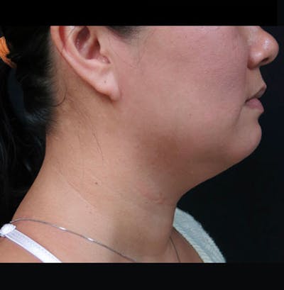 Non-Surgical Neck Lift Before & After Gallery - Patient 122909220 - Image 1