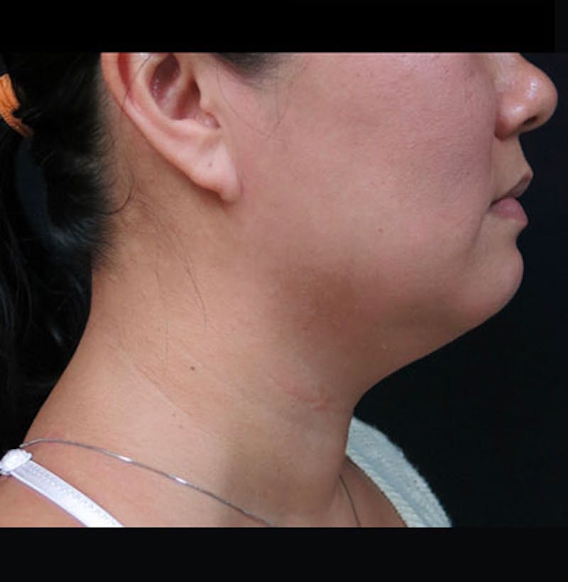 Non-Surgical Neck Lift Before & After Gallery - Patient 122909220 - Image 1