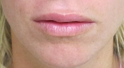 Lip Augmentation Before & After Gallery - Patient 122909219 - Image 2