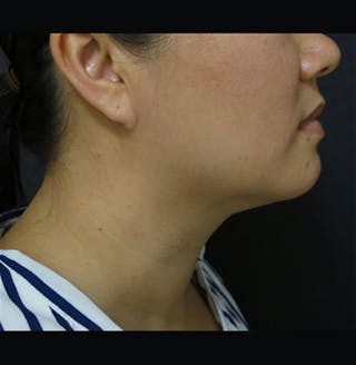 Non-Surgical Neck Lift Before & After Gallery - Patient 122909220 - Image 2