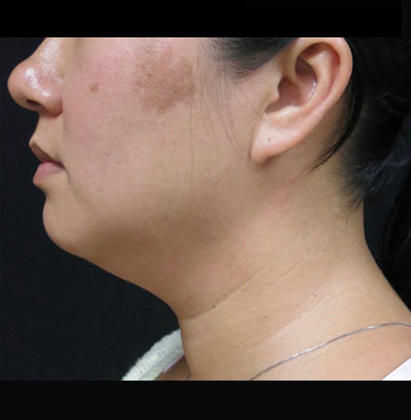 Non-Surgical Neck Lift Before & After Gallery - Patient 122909220 - Image 3