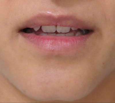 Lip Augmentation Before & After Gallery - Patient 122909221 - Image 1